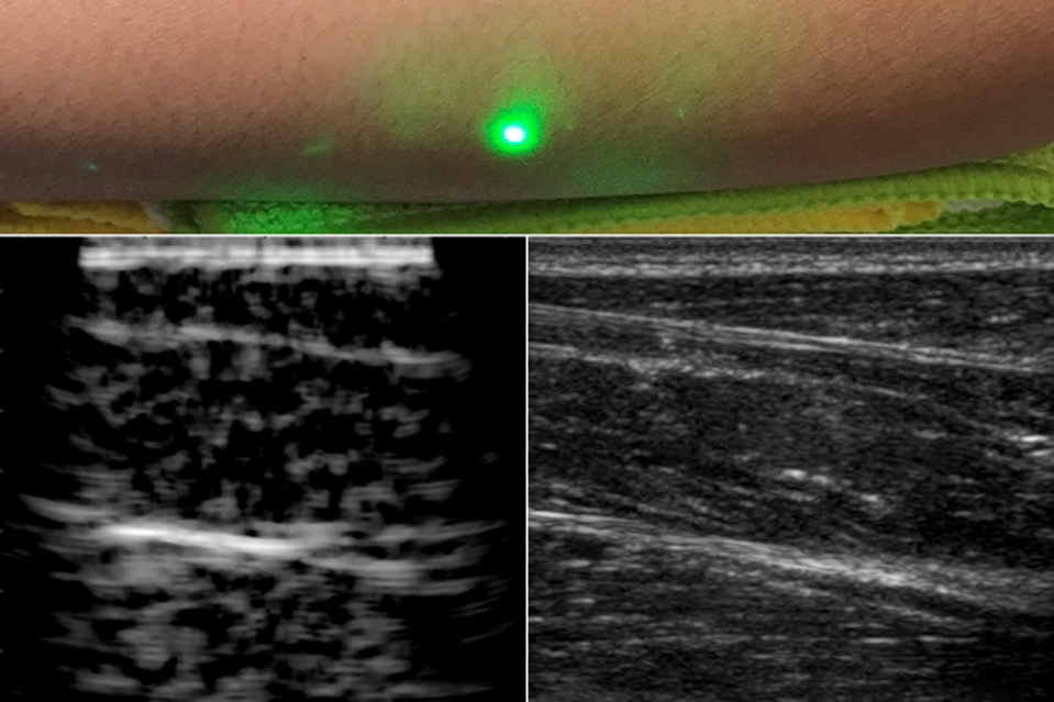 麻省理工的新激光超聲波技術，毋須接觸皮膚表面，以綠光（上）照射前臂所獲的體內深層組織影像（左），跟常規超聲波（右）相近。（MIT圖片）