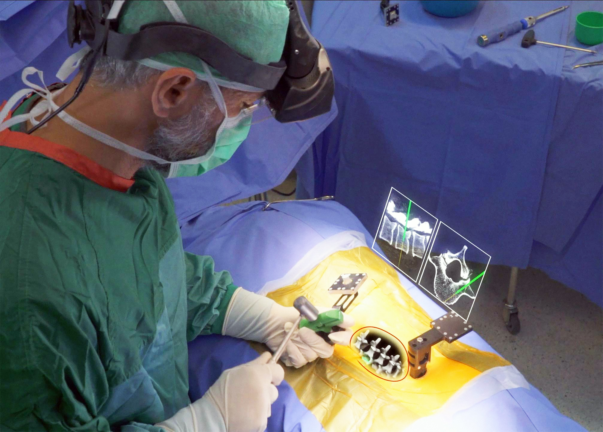醫生佩戴AR手術系統護目鏡，即可透視患者皮層及3D脊椎結構。（Augmedics圖片）