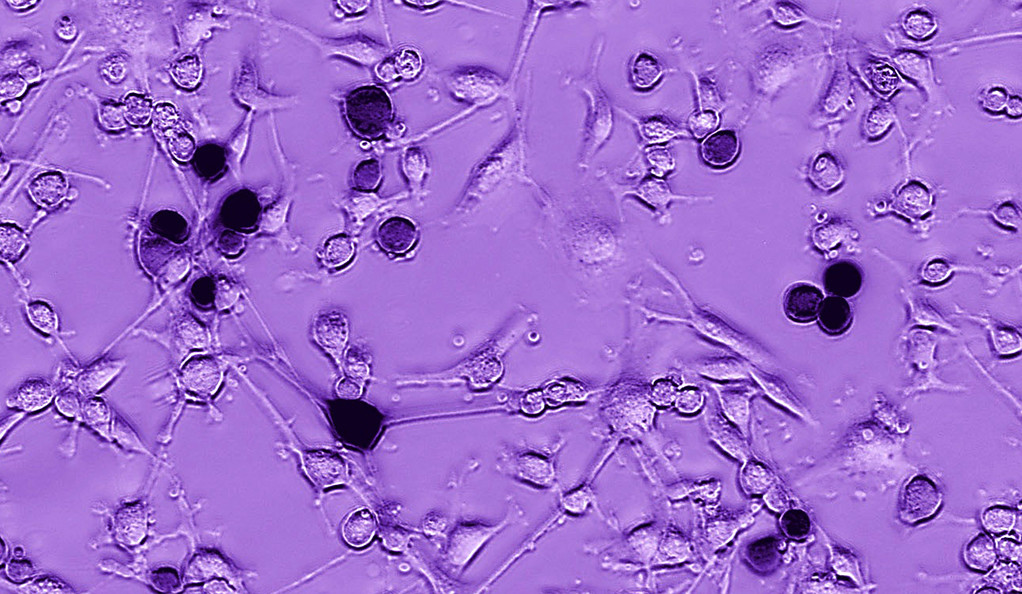 圖中黑色的伊波拉病毒基因，正攻擊膠質母細胞瘤細胞，功能類似標靶藥角色。（耶魯大學圖片）