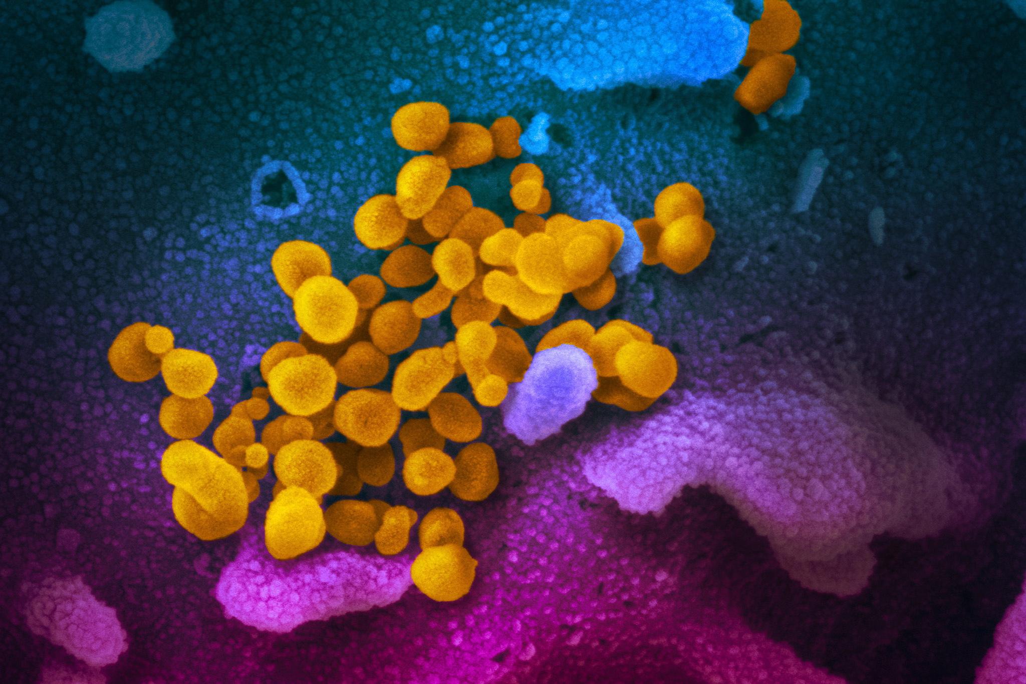 在電子顯微鏡下的新冠病毒真身（黃色圓點）。（NIH網上圖片）