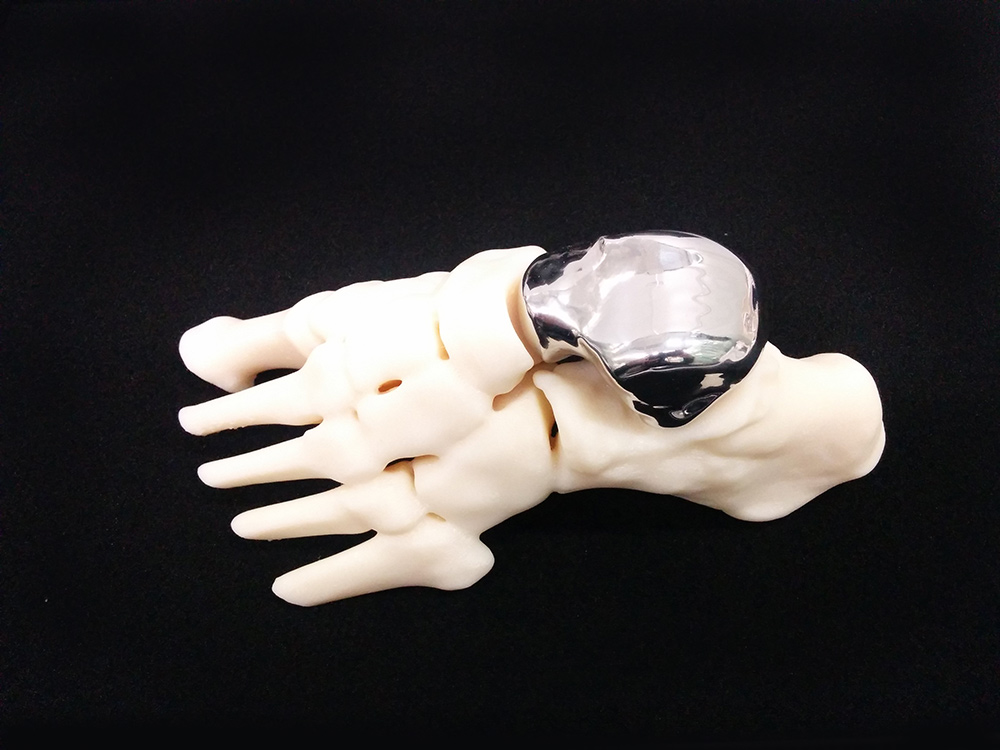 科能三維技術醫療有限公司為一宗交通意外傷者，以先進3D打印技術製造出按主診醫生要求的「骨頭要光滑」的金屬足踝。（KOLN網上圖片）