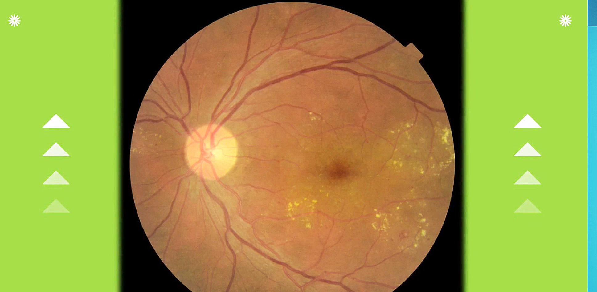 通過分析眼底照片，可以得知身體健康狀況，包括眼疾以至心腦血管疾病等先兆。（瞳訊醫療國際圖片）