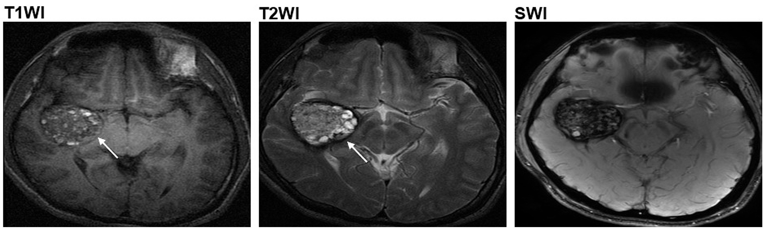 CCM二型患者於腦血管長有爆谷形狀腫瘤（箭嘴示）。（科大圖片）