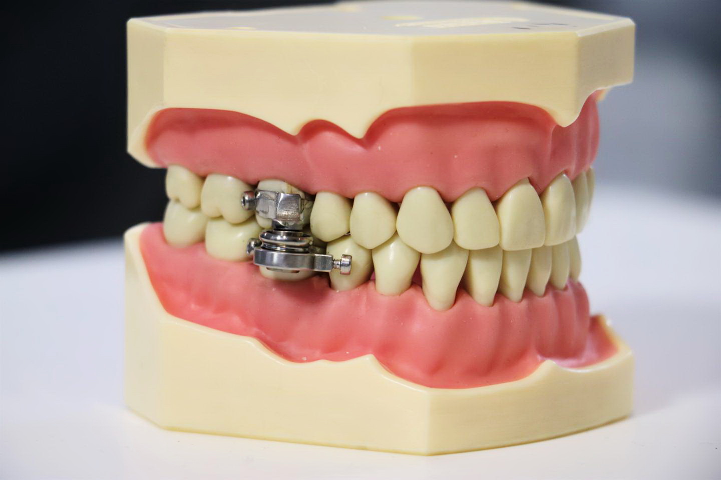 磁鐵牙鎖可連續或間歇使用，相比服用藥物或縮胃手術安全。（紐西蘭奧塔哥大學圖片）