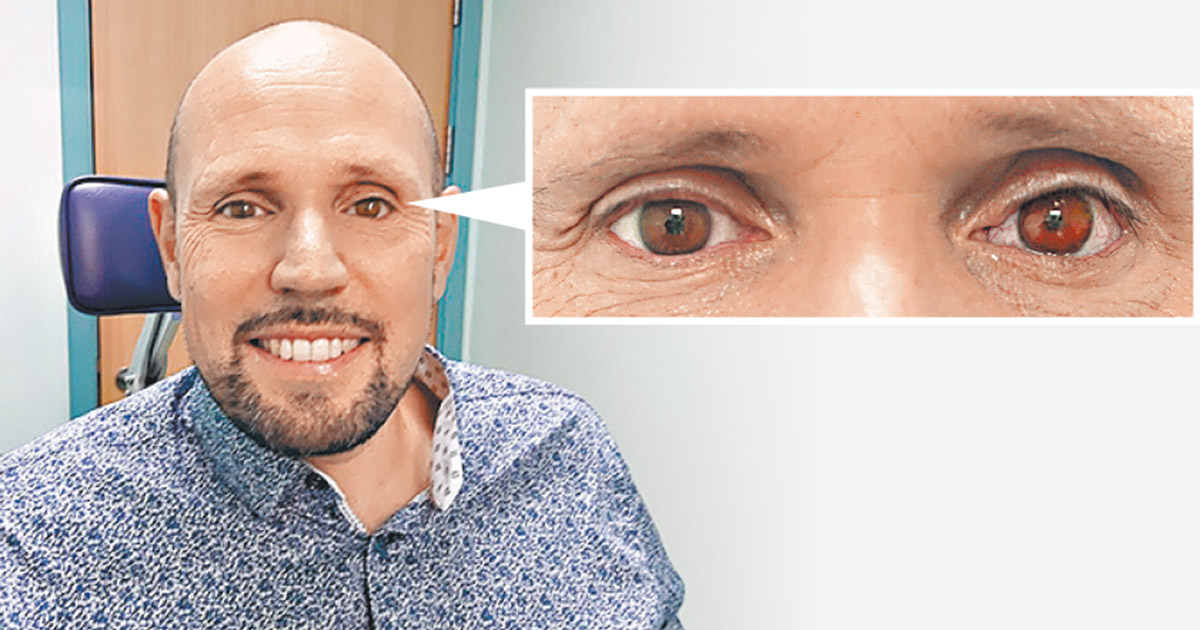 韋爾澤為左眼植入3D打印義眼，近看虹膜顏色略淺。（網上圖片）