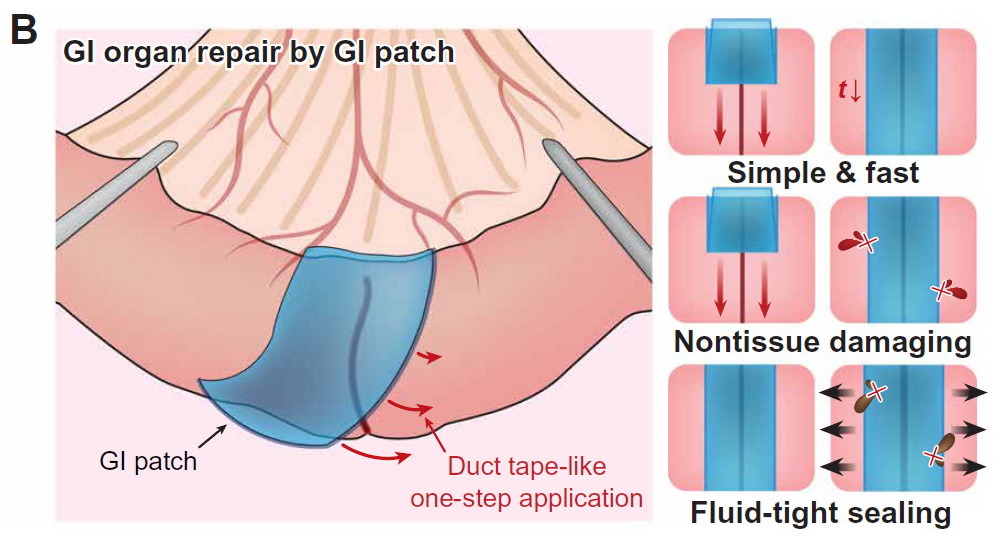 手術膠布有望應用於修復人體消化道的傷口，比傳統縫線更易用安全。（MIT圖片）