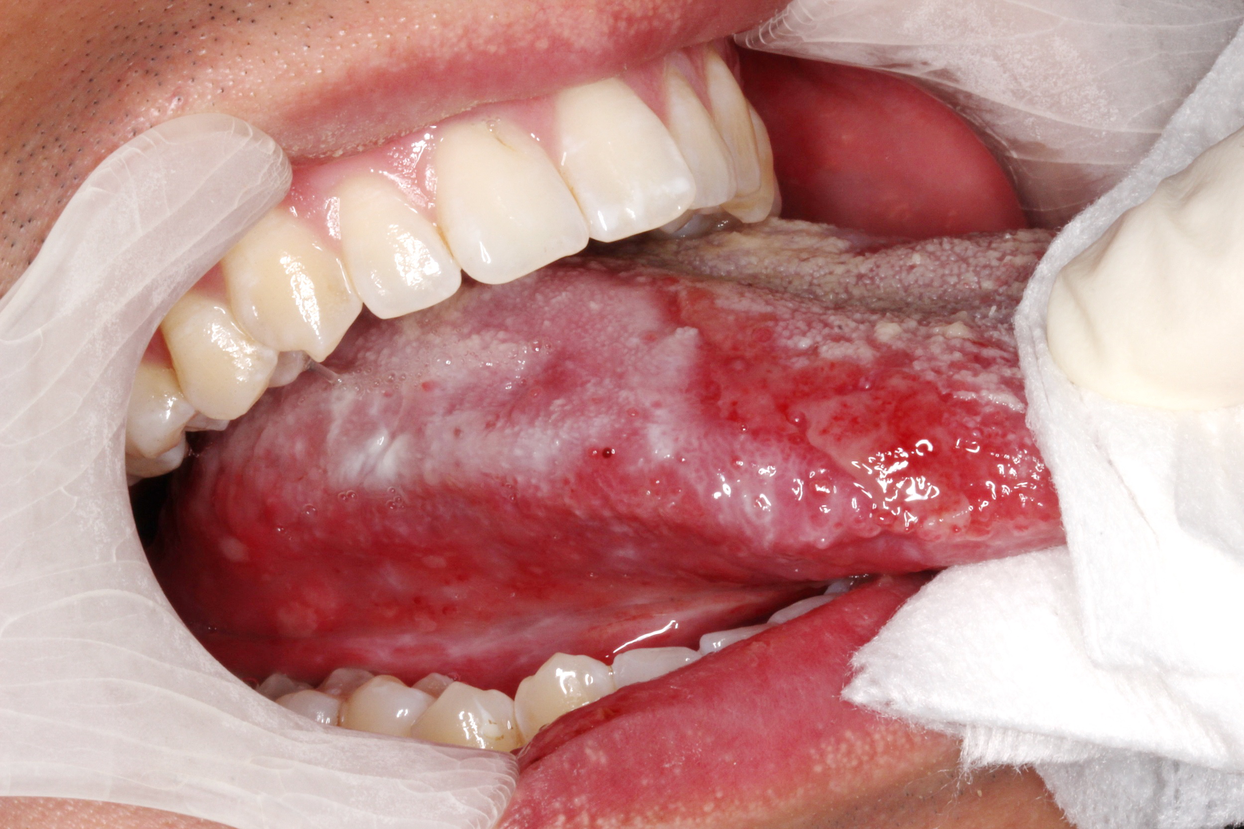 口腔癌初起表徵為口腔白斑，如圖中病人患有舌類扁平苔蘚黏膜炎。（港大網上圖片）