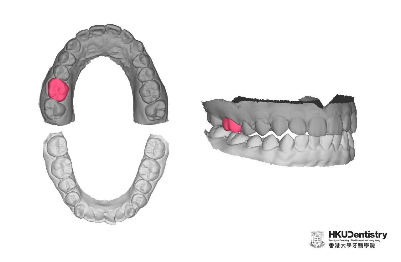 港大AI技術可按剩餘牙齒（深灰色）特徵，生成假牙形狀（紅色）。（港大網上圖片）